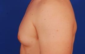 Gynecomastia Surgery Before & After Image
