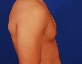 Gynecomastia Surgery Before & After Image