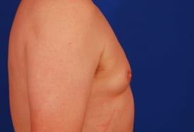 Gynecomastia Surgery Before & After Image