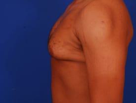 Gynecomastia Surgery Before & After Image
