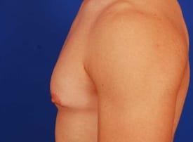 Gynecomastia Surgery Before & After Image