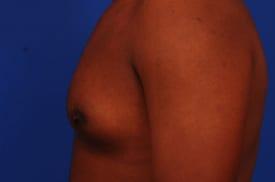 Gynecomastia Surgery Before & After Image
