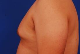 Gynecomastia Surgery Before & After Image