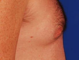 Gynecomastia Surgery Before & After Image