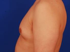 Gynecomastia Surgery Before & After Image