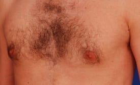 Gynecomastia Surgery Before & After Image