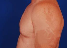 Gynecomastia Surgery Before & After Image