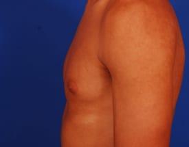 Gynecomastia Surgery Before & After Image