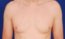 Gynecomastia Surgery Before & After Image