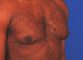 Gynecomastia Surgery Before & After Image