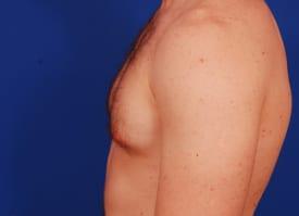 Gynecomastia Surgery Before & After Image