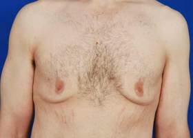 Gynecomastia Surgery Before & After Image