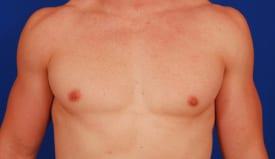 Gynecomastia Surgery Before & After Image