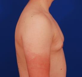 Gynecomastia Surgery Before & After Image