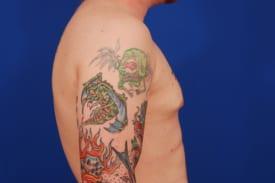 Gynecomastia Surgery Before & After Image
