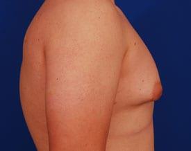 Gynecomastia Surgery Before & After Image