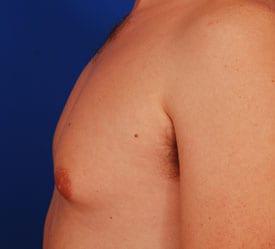 Gynecomastia Surgery Before & After Image