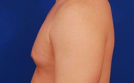 Gynecomastia Surgery Before & After Image