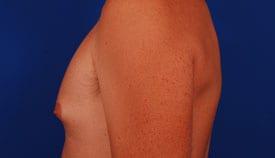 Gynecomastia Surgery Before & After Image