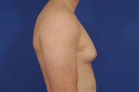 Gynecomastia Surgery Before & After Image