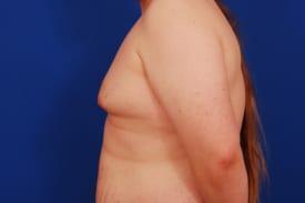 Gynecomastia Surgery Before & After Image