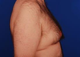Gynecomastia Surgery Before & After Image
