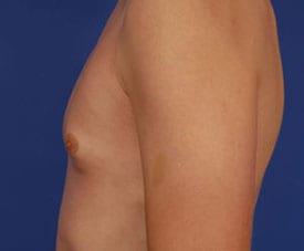 Gynecomastia Surgery Before & After Image