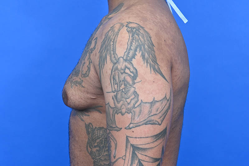 Revision Gynecomastia Surgery Before & After Image