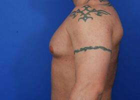 Revision Gynecomastia Surgery Before & After Image