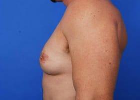 Revision Gynecomastia Surgery Before & After Image