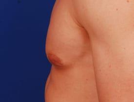 Revision Gynecomastia Surgery Before & After Image