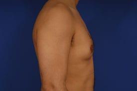 Revision Gynecomastia Surgery Before & After Image