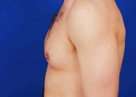 Austin Gynecomastia Surgery patient Before