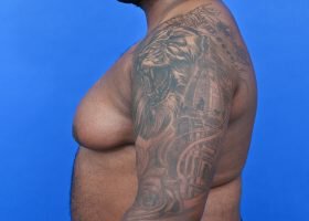 Austin Gynecomastia Surgery patient Before