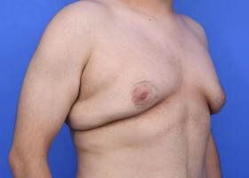 Before Austin Gynecomastia Surgery patient