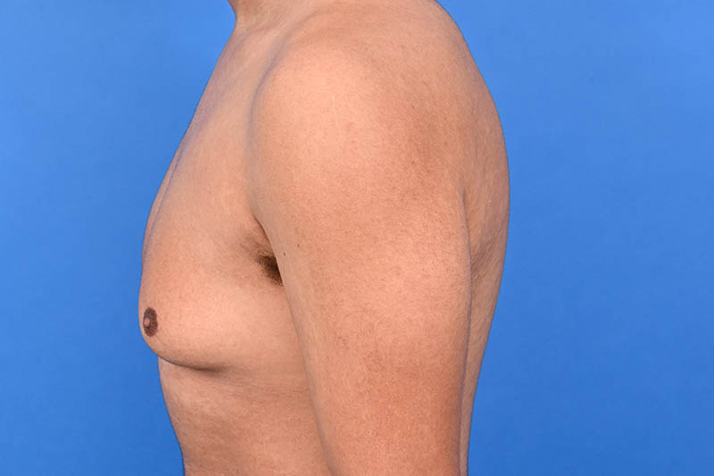 Gynecomastia Surgery Before & After Image
