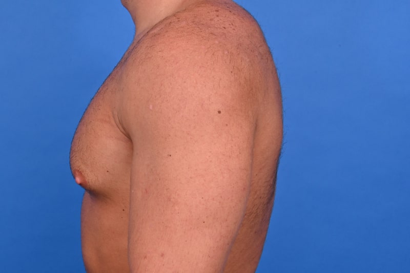 Gynecomastia Surgery Before & After Image