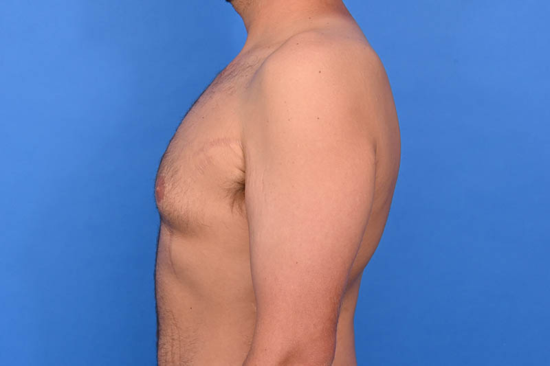 Gynecomastia Surgery Before & After Image