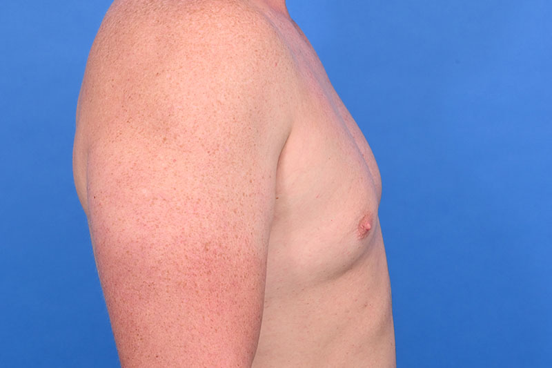 Gynecomastia Surgery Before & After Image