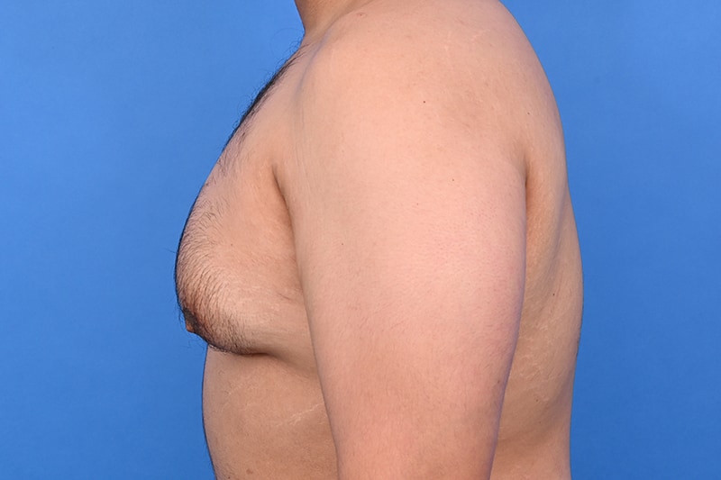 Gynecomastia Surgery Before & After Image