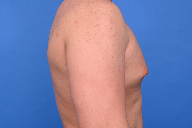 Gynecomastia Surgery Before & After Image