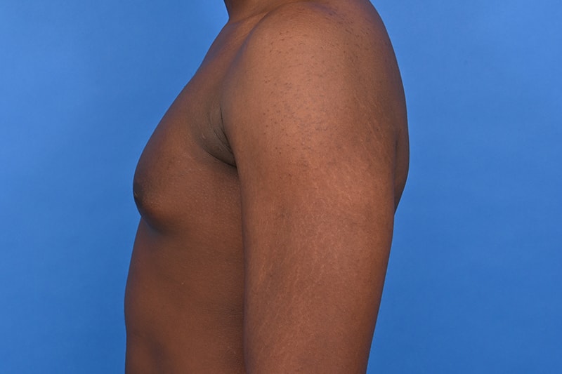 Gynecomastia Surgery Before & After Image