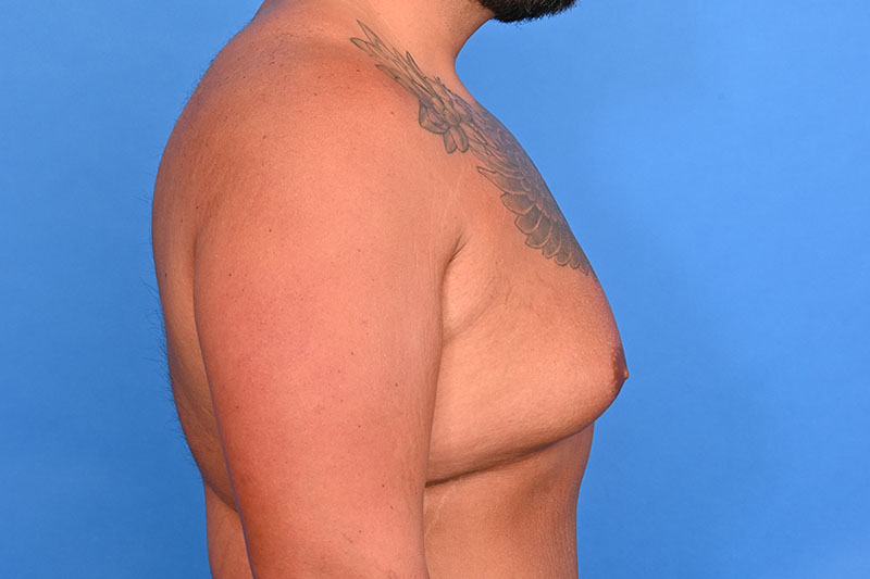 Gynecomastia Surgery Before & After Image