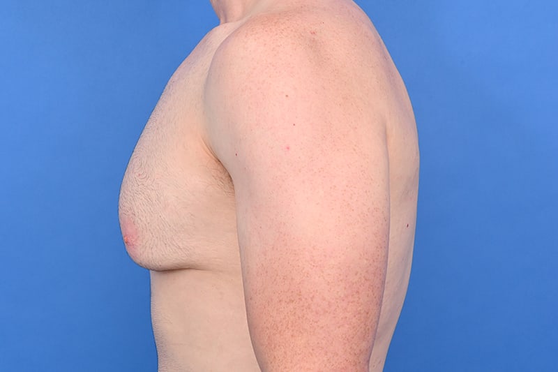 Gynecomastia Surgery Before & After Image