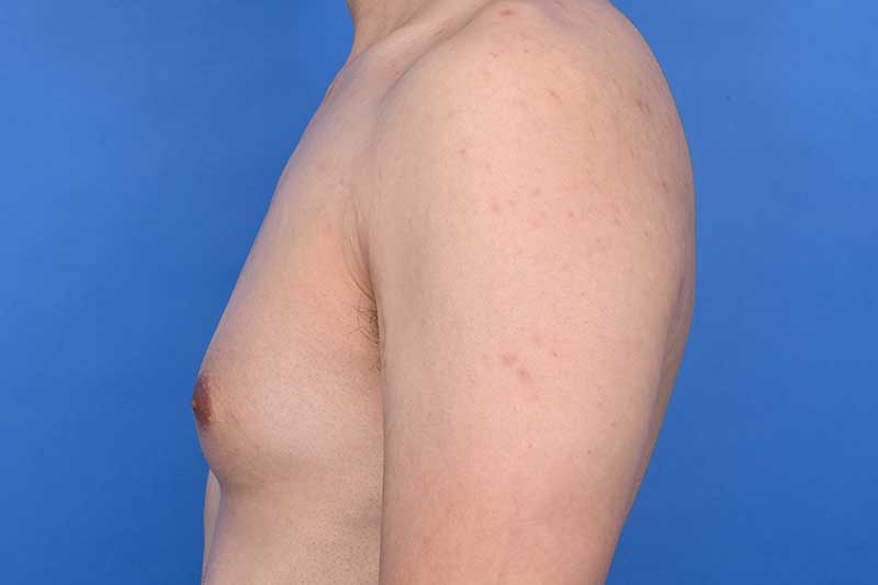 Gynecomastia Surgery Before & After Image