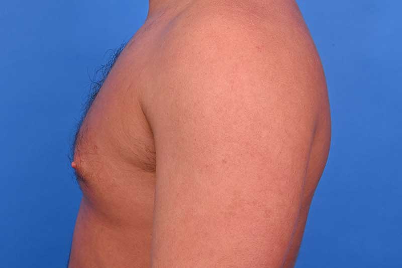 Gynecomastia Surgery Before & After Image