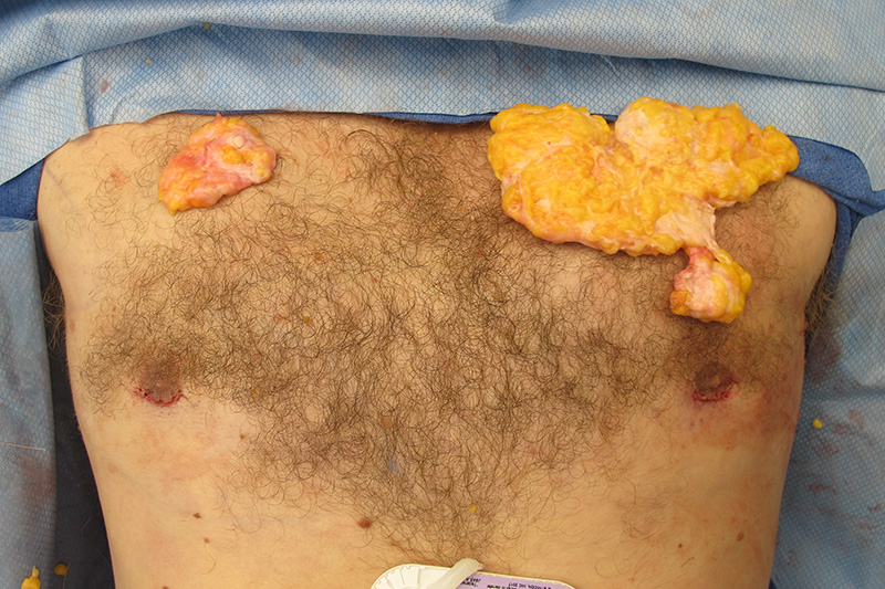 Gynecomastia Surgery Before & After Image