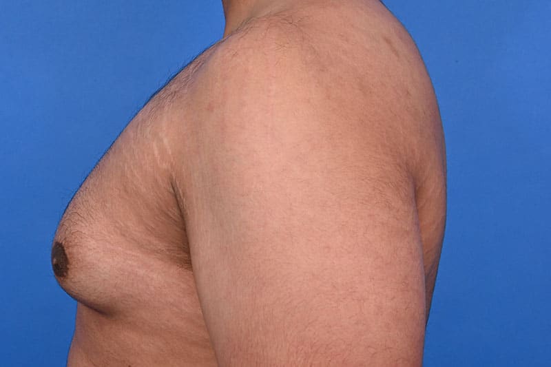 Gynecomastia Surgery Before & After Image