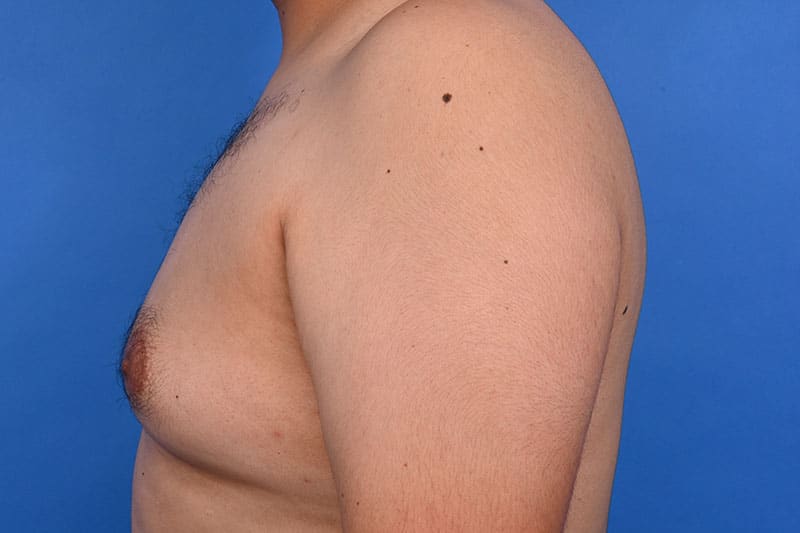 Gynecomastia Surgery Before & After Image