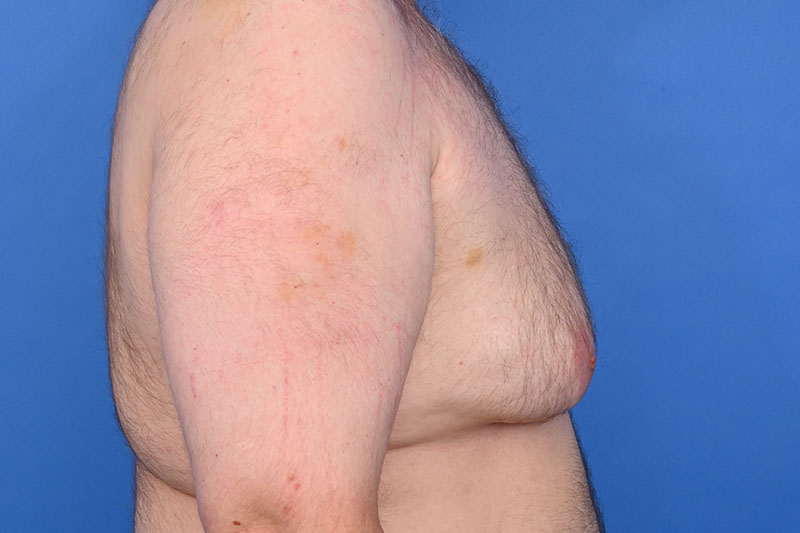 Gynecomastia Surgery Before & After Image